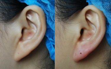 洛陽手術(shù)疤痕去除哪家好？選擇靠譜專業(yè)的洛陽疤痕修復(fù)中心