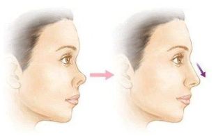 長(zhǎng)沙美萊潘衛(wèi)峰做脂肪填充效果如何？醫(yī)生經(jīng)驗(yàn)口碑詳細(xì)了解！