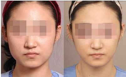 河南去胎記哪家醫(yī)院好？解析最適合您的整形醫(yī)院