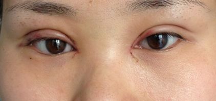 沈陽(yáng)哪家醫(yī)院疤痕手術(shù)效果好？