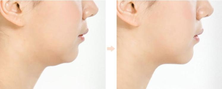 2023深圳面部填充面部皺紋專家前十名排行(曹琛、符國興、雋洪艷這些醫(yī)生權(quán)威有實力，值得信賴)