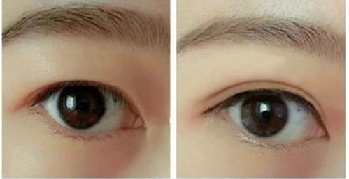 揭秘！哈爾濱哪家醫(yī)院的隆鼻手術(shù)效果最好推薦