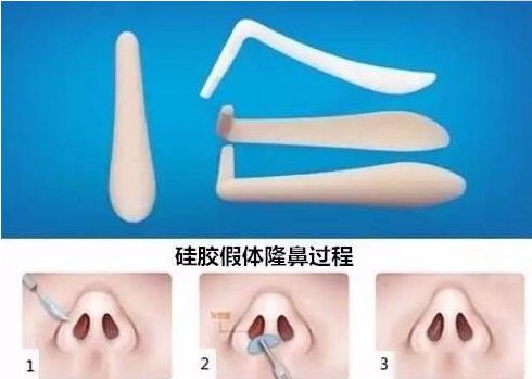 北京哪家醫(yī)院祛除眼袋效果最好？