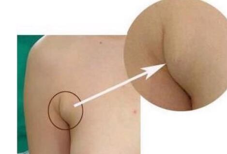 張誠教授為您的雙眼皮修復提供完美解決方案！成功案例分享，糾正雙眼皮失敗的救星~