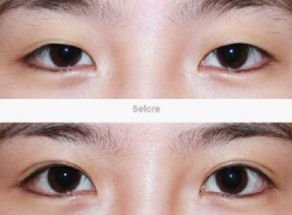 昆明哪家醫(yī)院的隆鼻整形效果好？