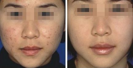 連云港眼部激光飛秒那家好？排名領(lǐng)先的專業(yè)眼科醫(yī)院推薦