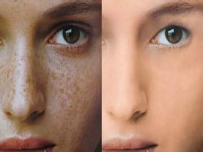 2023北京光子去雀斑排行榜前10名的醫(yī)生(武崇高、王凱瀠、邢志花在榜內(nèi))