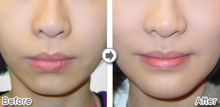 武漢熱瑪吉技術(shù)治療最好的醫(yī)院是哪家？