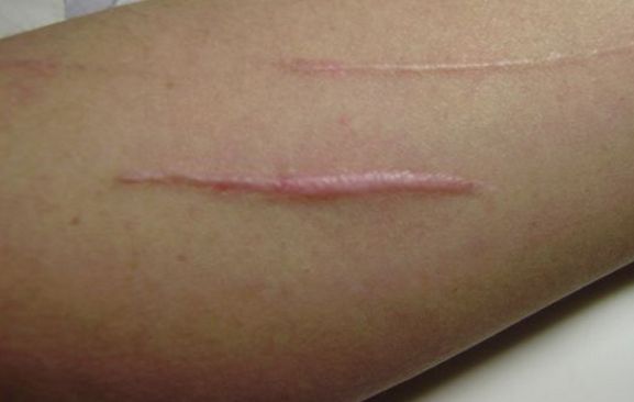 深圳哪家醫(yī)院的取膨體效果最好？