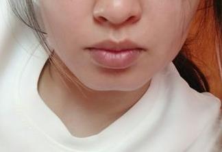 2023溫州疤痕微創(chuàng)手術正規(guī)專家前10位(蔡東亮、張波、王津評價看是網紅收費也不坑人)