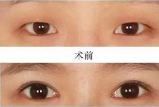 昆明哪家醫(yī)院做熱瑪吉好？挑選昆明熱瑪吉治療專業(yè)的醫(yī)院指南