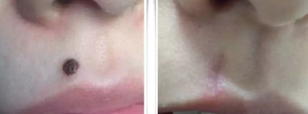 福州割眼袋醫(yī)院排行榜2023：哪家醫(yī)院割眼袋好？