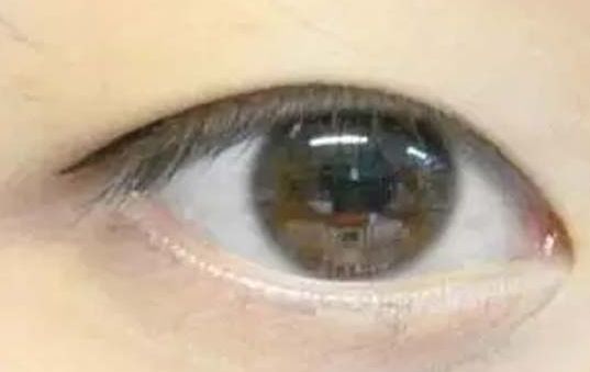 揭曉2023年武漢哪家醫(yī)院割雙眼皮好，專家推薦及真實(shí)案例！