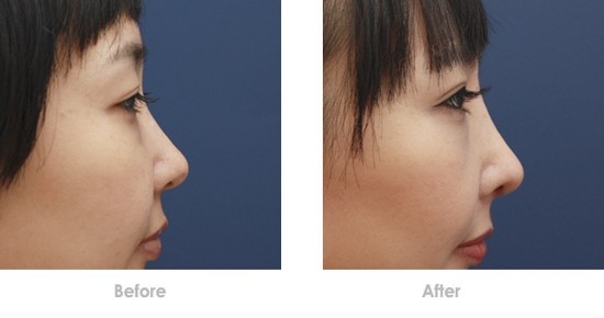 2023寧波激光去咖啡斑膨體隆鼻醫(yī)生前10強(qiáng)排名(鄔薇薇、高文彬、郭光燁經(jīng)驗(yàn)豐富不？)