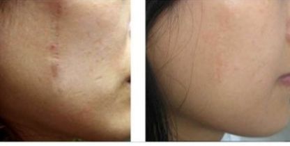 南京開雙眼皮哪家醫(yī)院好？幫你解析南京哪家醫(yī)院做開雙眼皮效果最好