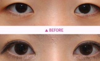 洛陽哪家雙眼皮醫(yī)院專業(yè)又靠譜？