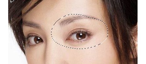 成都米蘭柏羽盧尚兵雙眼皮是否有效？美杜莎美眼術(shù)技術(shù)真如傳說(shuō)中那么神奇？