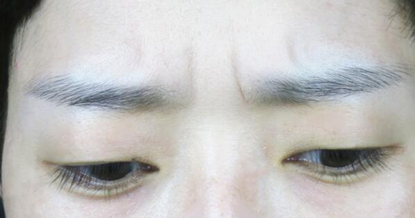 林沸騰整形醫(yī)院福州隆胸手術(shù)效果評(píng)價(jià)