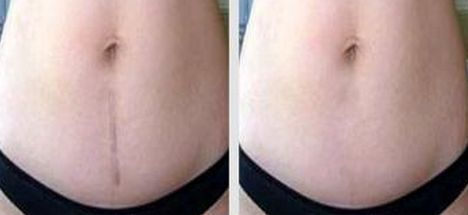 聊城激光祛痘醫(yī)院哪家好？選擇聊城最適合你的激光祛痘醫(yī)院