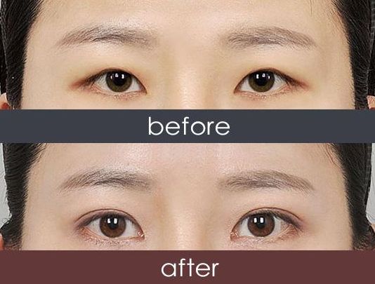 福州哪家醫(yī)院激光祛雀斑效果好？