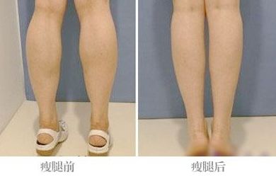 全國激光點痣哪家醫(yī)院好？帶你全面了解最佳選擇！