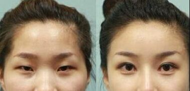 深圳隆鼻手術(shù)效果如何？哪家醫(yī)院的鼻綜合技術(shù)較好？