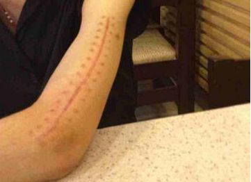 哈爾濱疤痕醫(yī)院哪家好？2023最新排名及患者口碑綜合分析