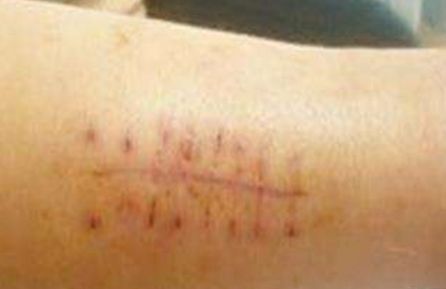 重慶治療雀斑靠譜的醫(yī)院有哪些？