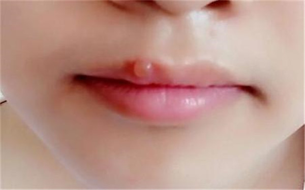 2023廣州嗨體去口周紋權(quán)威專家口碑TOP10強(qiáng)(周三民、李永翰、李壘壘明白人說價(jià)格實(shí)惠)