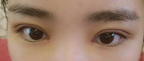 福州哪里可以去除胎記？福州去胎記醫(yī)院排名哪家好？