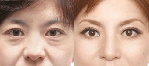 成都做乳暈漂紅哪家好？乳暈漂紅的價(jià)格、效果、方法哪種最合適？