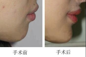 昆明哪家醫(yī)院做上臉下垂手術(shù)好，醫(yī)生技術(shù)靠譜？