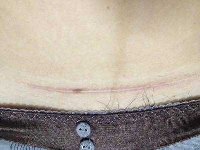 2023內(nèi)蒙古吸脂瘦身腹權(quán)威專家上榜前幾(李曉梅、劉露、韓楓技術(shù)、審美、口碑通通有)