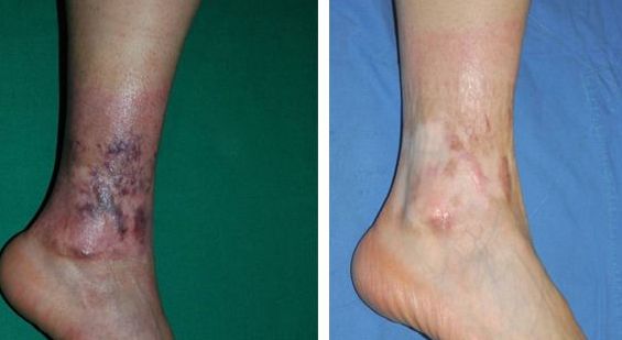 上海手術點痣醫(yī)院哪家好？揭秘上海最受歡迎的點痣醫(yī)院