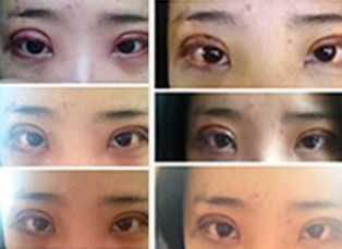 長沙哪家醫(yī)院的拉皮手術(shù)最好？專家推薦的拉皮手術(shù)醫(yī)院有哪些？