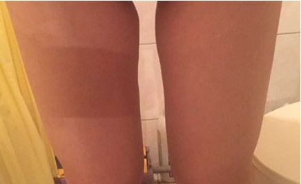 山東哪家醫(yī)院治療疤痕好？挑選最適合您的醫(yī)療機構(gòu)！