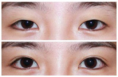 2023安徽韓式三點雙眼皮權(quán)威專家排名前十(劉愛國、王凱、朱飛口碑評價都很高)