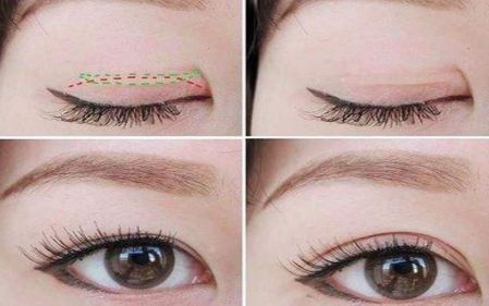 上海打臥蠶哪家醫(yī)院好？選擇上海治療臥蠶一流的醫(yī)院