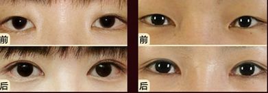 嘟嘟唇無(wú)錫哪家醫(yī)院好？專(zhuān)家推薦無(wú)錫哪家醫(yī)院治療嘟嘟唇好