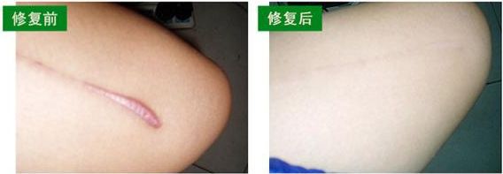 上海微創(chuàng)除皺哪家醫(yī)院好？了解上海微創(chuàng)除皺治療的專業(yè)醫(yī)院推薦