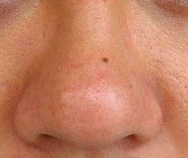 2023上海剝脫祛黑痣口碑排名前10名醫(yī)生(唐鏖、姚智文、趙設(shè)計技術(shù)實力強，更值得信賴)