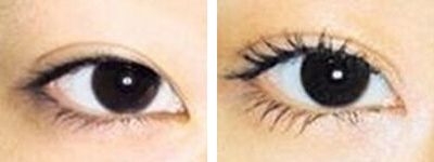 深圳祛痘印痘疤那家醫(yī)院靠譜且經(jīng)濟(jì)實惠？