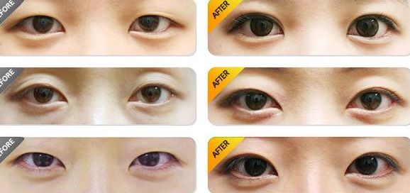 北京做雙眼皮哪家醫(yī)院好？排名最靠前的北京雙眼皮醫(yī)院有哪些？