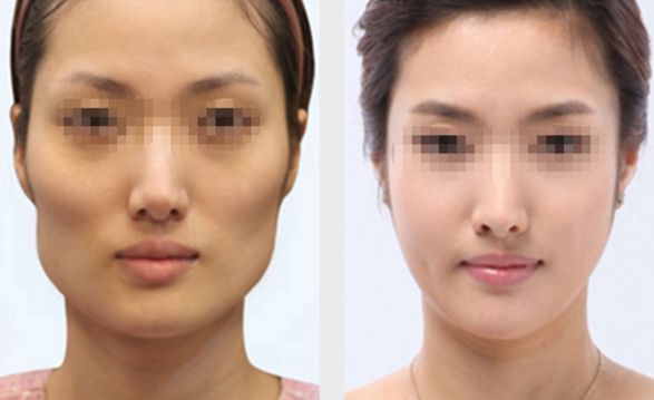 長(zhǎng)春雙眼皮修復(fù)好的醫(yī)院有哪些？