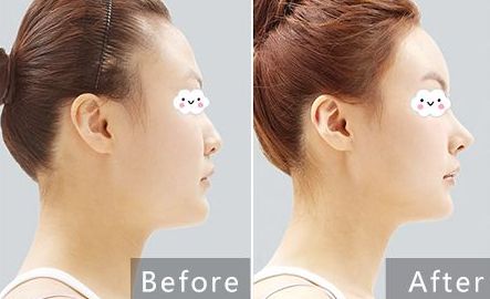 貴陽治療痘坑哪家醫(yī)院專業(yè)可靠？