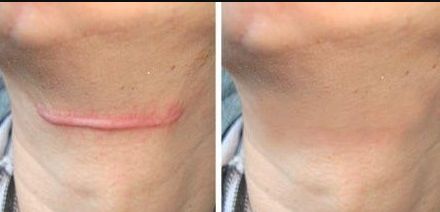 成都市開眼角醫(yī)院哪家好？選擇適合你的開眼角醫(yī)院