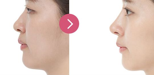 揚(yáng)州私密整形哪家好？專業(yè)推薦！