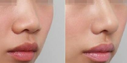 深圳修復雙眼皮哪家醫(yī)院好？淺談深圳雙眼皮修復專家排行榜