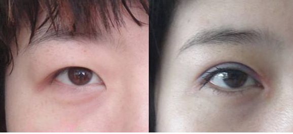 上海市激光修復(fù)痘坑效果如何？哪家醫(yī)院技術(shù)更好？