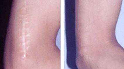 哈爾濱哪家醫(yī)院去除痘痘增生效果好，推薦給大家！